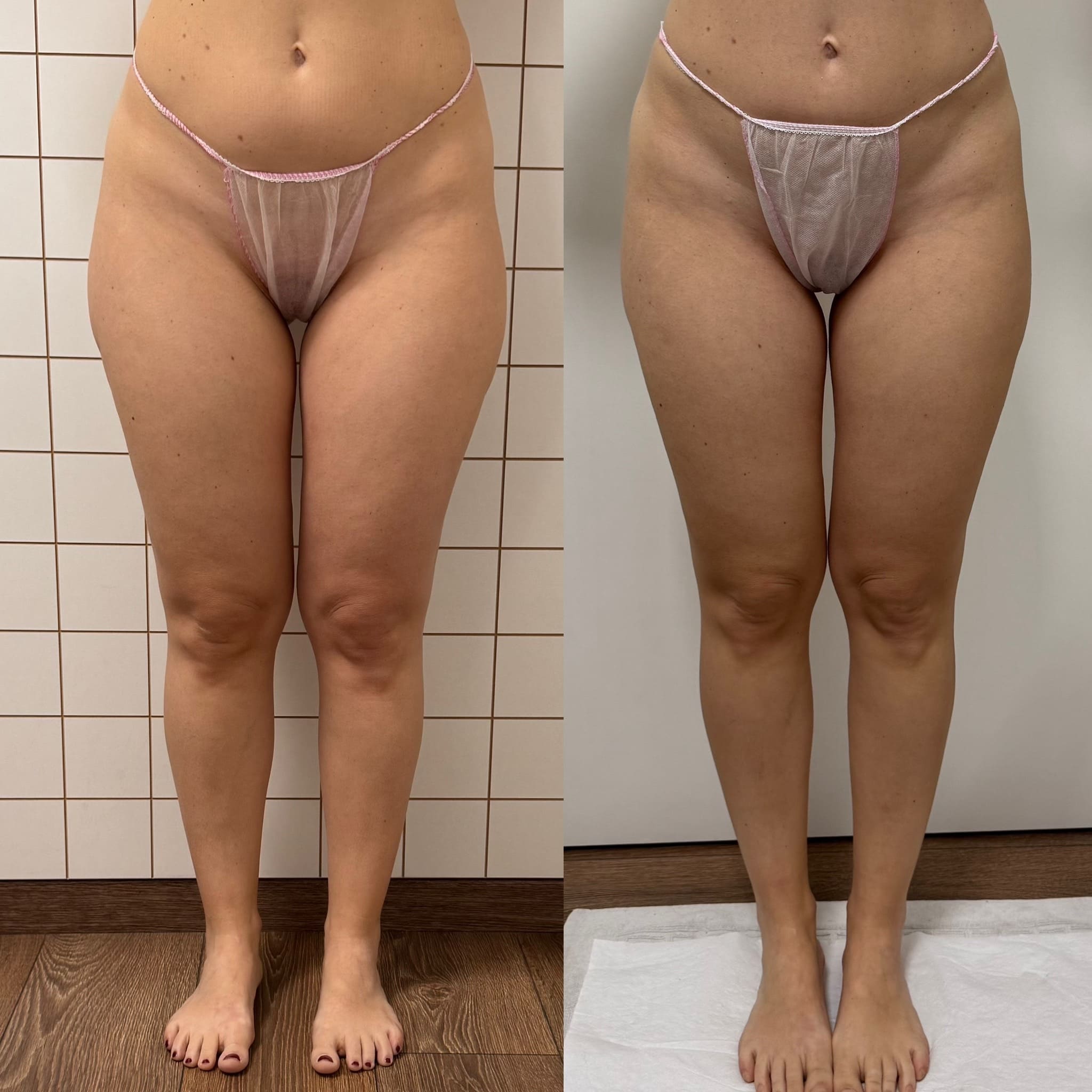 Risultato trattamento Body [R]Evolution — prima e dopo